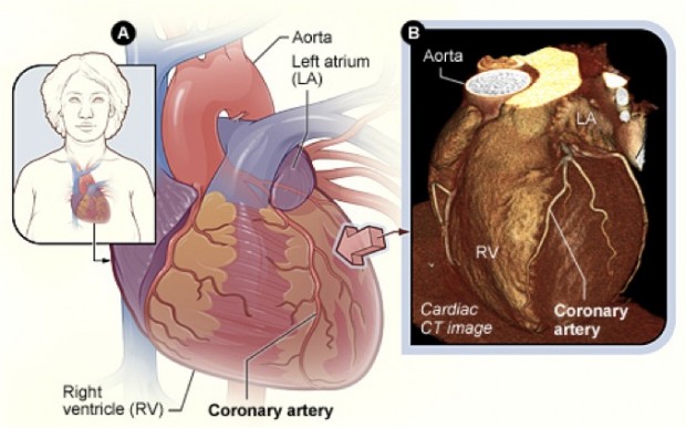 cardiac-ct