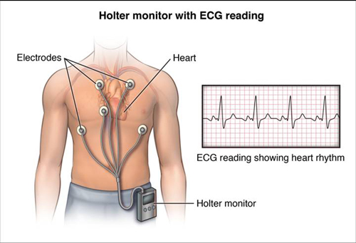 24-hour Holter monitoring: Uses, results, and what to expect
