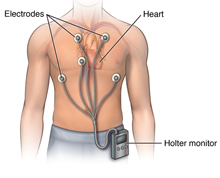 holter-monitor