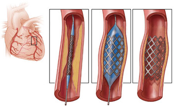 Interventional Cardiology and Coronary Angioplasty(PCI) - Premier Heart Care Ltd.